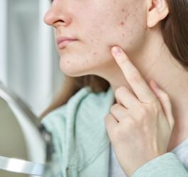 Kobieta przegląda się w lustrze, na twarzy widać typowe objawy trądziku pospolitego.