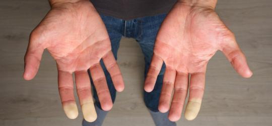 Objaw Raynauda u pacjenta, będący jednym z objawów twardziny układowej.