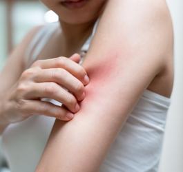 Kobieta drapie się po podrażnionej skórze, ma uczulenie na nikiel.