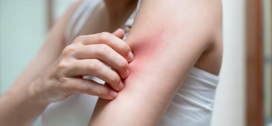 Kobieta drapie się po podrażnionej skórze, ma uczulenie na nikiel.
