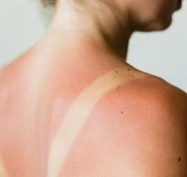 Kobieta z widocznym uczuleniem na słońce na skórze pleców.