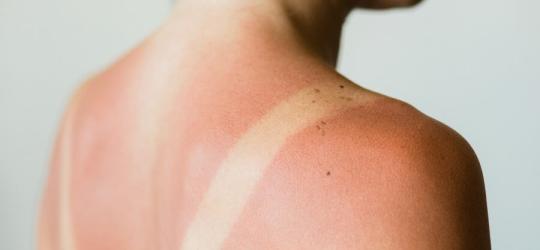 Kobieta z widocznym uczuleniem na słońce na skórze pleców.