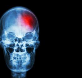 Udar mózgu - przyczyny i leczenie