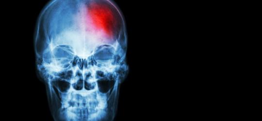 Udar mózgu - przyczyny i leczenie