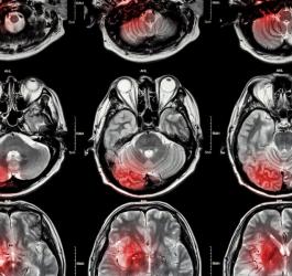 Udar niedokrwienny - czym jest i jak się go leczy?