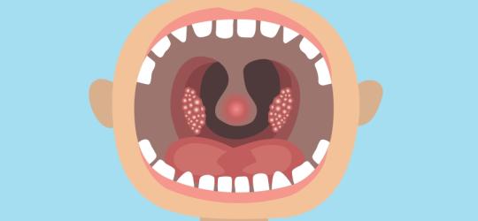 Usuwanie migdałków u dzieci