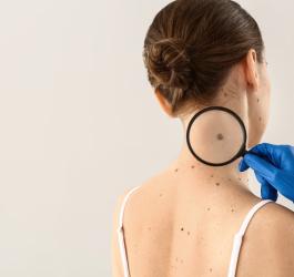 Kobieta ma dużo znamion skórnych. Lekarz sprawdza jedno z nich pod szkłem powiększającym.