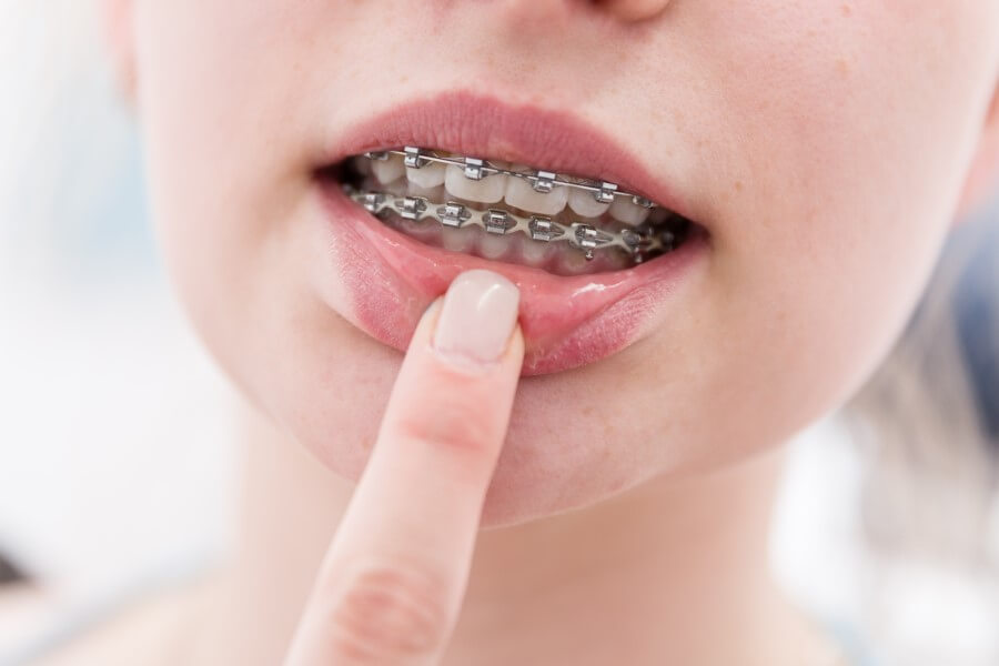 Kobieta pokazuje uszkodzenia błony śluzowej jamy ustnej po aparacie ortodontycznym.