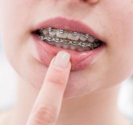 Kobieta pokazuje uszkodzenia błony śluzowej jamy ustnej po aparacie ortodontycznym.