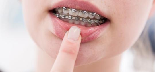 Kobieta pokazuje uszkodzenia błony śluzowej jamy ustnej po aparacie ortodontycznym.