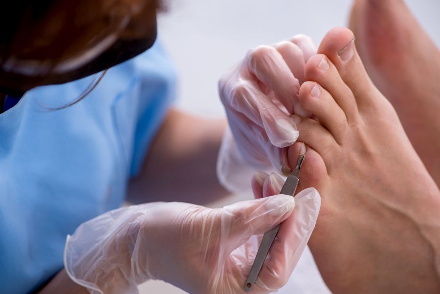 Wrastający paznokieć