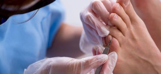 Wrastający paznokieć