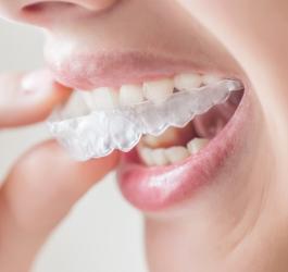 Wybielanie zębów: w domu czy u stomatologa?