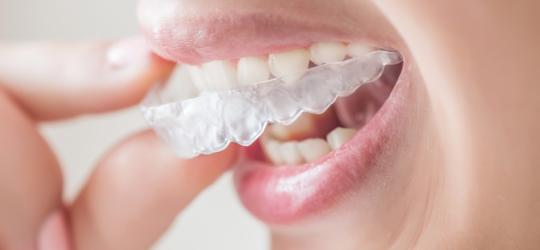 Wybielanie zębów: w domu czy u stomatologa?