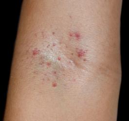 Widoczne na skórze, niewielkie wybroczyny.