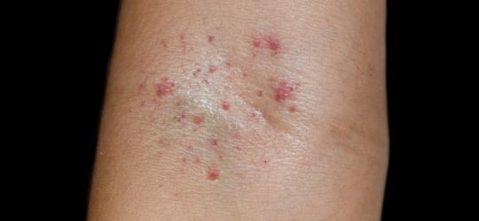 Widoczne na skórze, niewielkie wybroczyny.