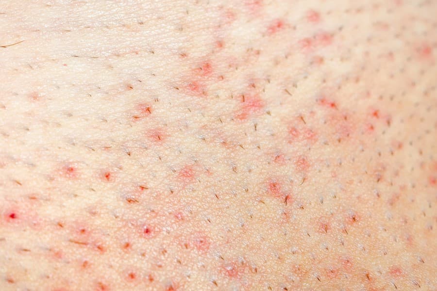 Skóra z widocznym zapaleniem mieszków włosowych.