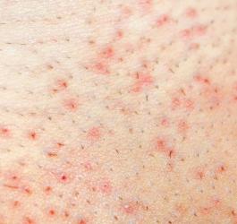 Skóra z widocznym zapaleniem mieszków włosowych.