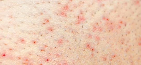 Skóra z widocznym zapaleniem mieszków włosowych.