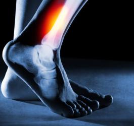 Prześwietlenie kości nogi z widocznym zapaleniem okostnej.