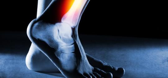 Prześwietlenie kości nogi z widocznym zapaleniem okostnej.