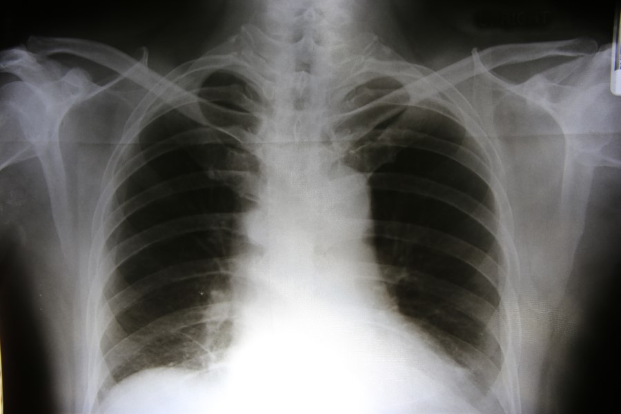 RTG klatki piersiowej w diagnostyce zatorowości płucnej.
