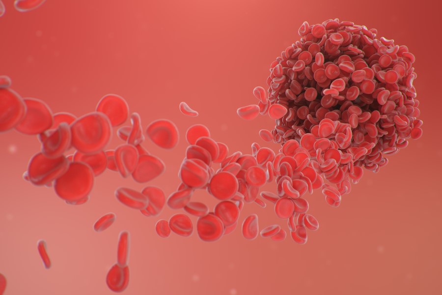 Zakrzep będący objawem zespołu antyfosfolipidowego.