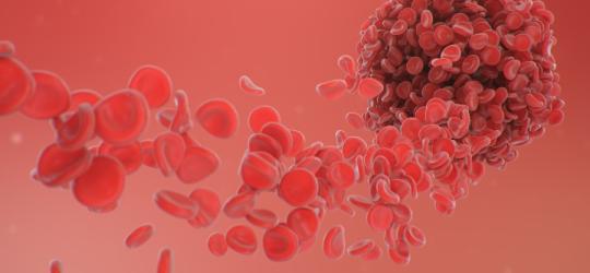 Zakrzep będący objawem zespołu antyfosfolipidowego.