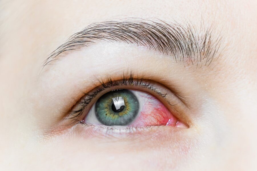 Zaczerwienie oko - to jeden z objawów zespołu Sjogrena.