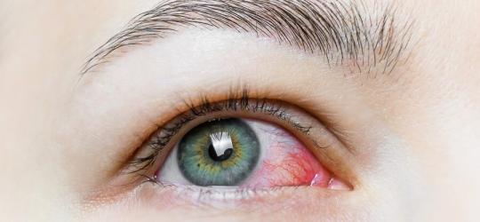 Zaczerwienie oko - to jeden z objawów zespołu Sjogrena.