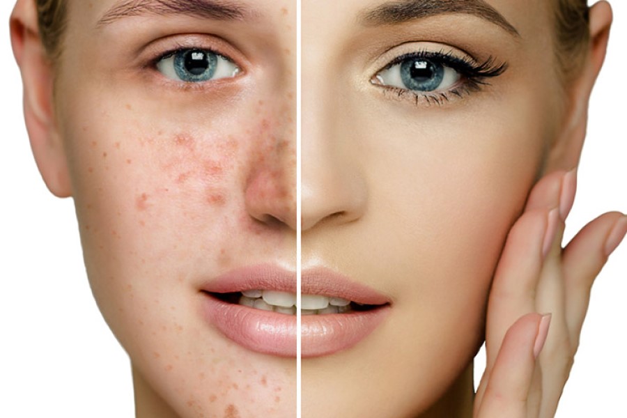Twarz kobiety w dwóch odsłonach - jedna z widocznym trądzikiem, druga bez niedoskonałości.