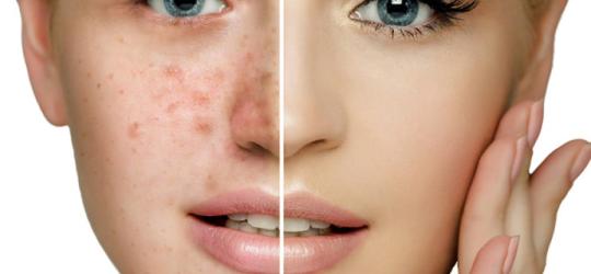 Twarz kobiety w dwóch odsłonach - jedna z widocznym trądzikiem, druga bez niedoskonałości.