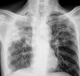 RTG klatki piersiowej i widoczne zwłóknienie płuc.