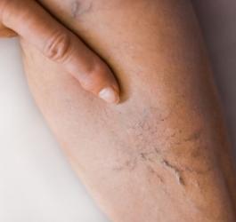 Kobieta pokazuje żylaki widoczne pod powierzchnią skóry.